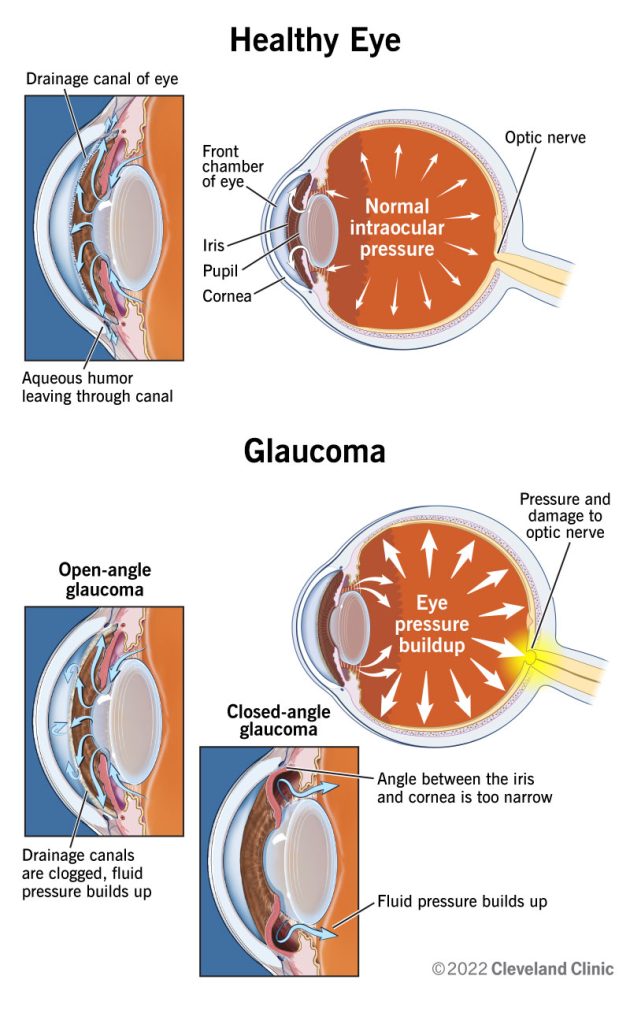 Normal and Glaucoma Eye
